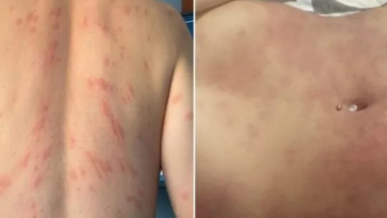 Alergias en Quillón