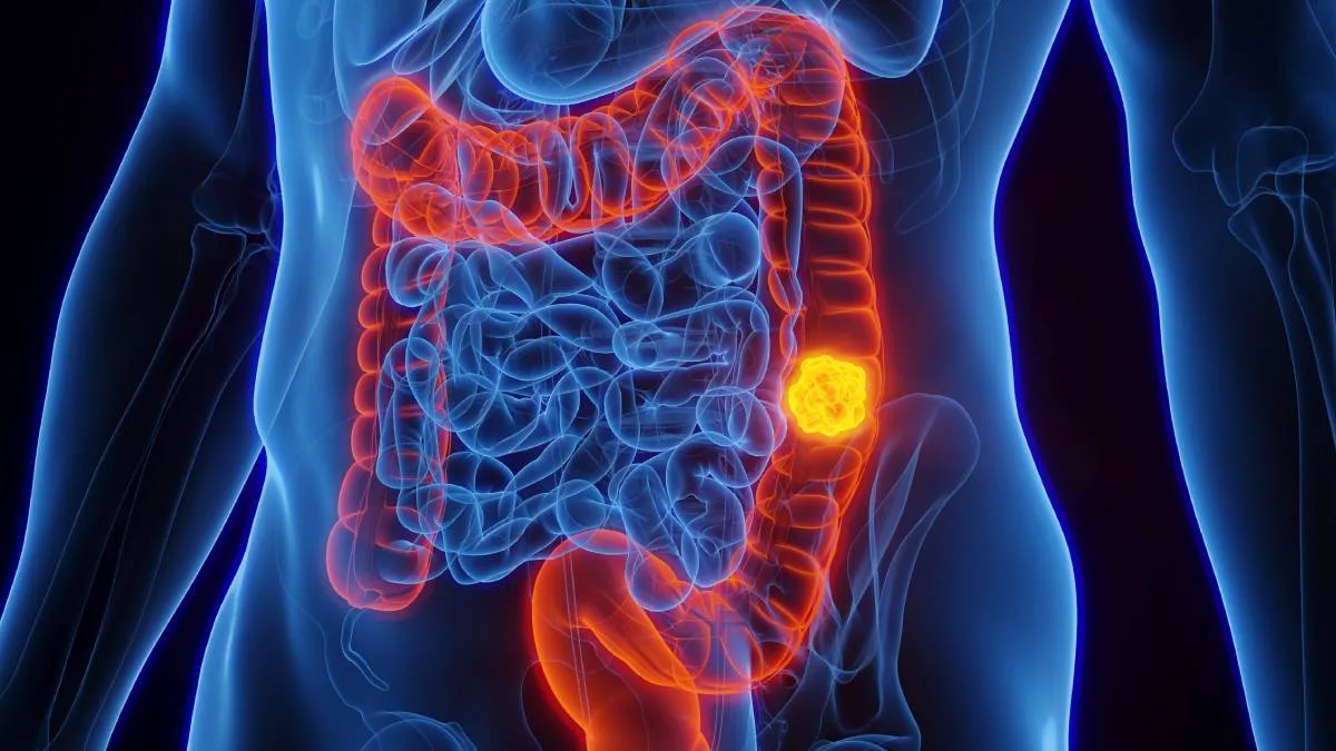 Cancer Colorrectal 2