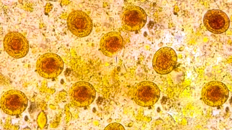 Triquinosis