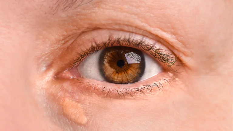 Xantelasma