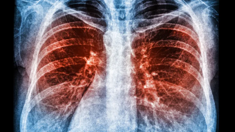 Peste Pulmonar